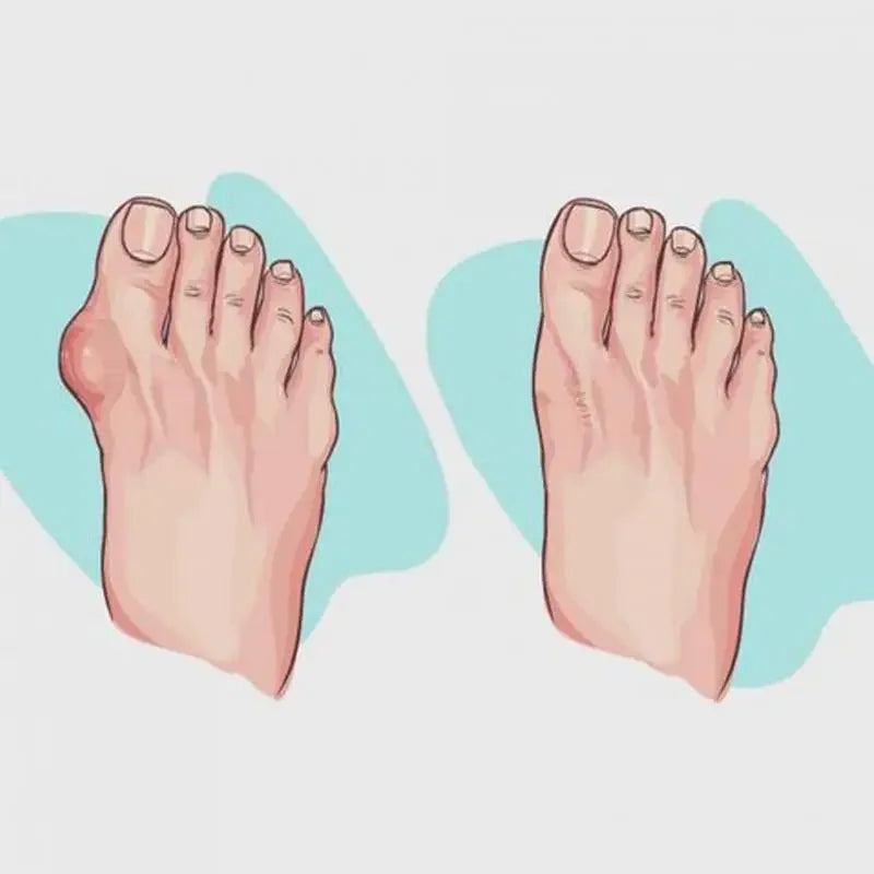 2025 Women Shoes Slippers Orthopedic Bunion Corrector Comfy Platform Ladies Casual Big Toe Correction Sandal Sandalias De Mujer